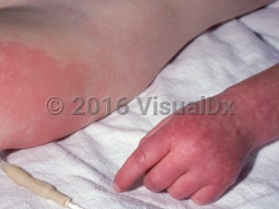 Clinical image of Familial dysautonomia - imageId=1551452. Click to open in gallery.  caption: 'Cutaneous hyperactivity, showing brightly erythematous plaques on the thigh and mottling on the hand.'