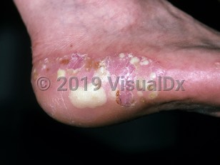 Clinical image of Palmoplantar pustulosis - imageId=155213. Click to open in gallery.  caption: 'Several large pustules, some brown incipient crusts, and superficial scale on the heel.'