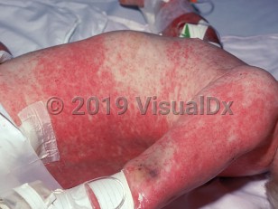Clinical image of Acquired pancytopenia - imageId=1552640. Click to open in gallery.  caption: 'Widespread purpuric patches and petechiae on the trunk and arms.'