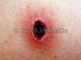 Clinical image of Scrub typhus - imageId=1554211. Click to open in gallery.  caption: 'A close-up of an eschar with a bright red border.'