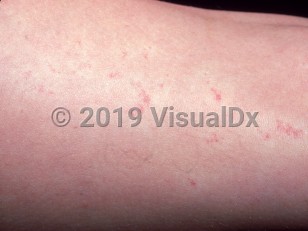 Clinical image of Unilateral nevoid telangiectasias - imageId=1554823. Click to open in gallery.  caption: 'Close-up of numerous red, telangiectatic macules and papules with surrounding haloes.'