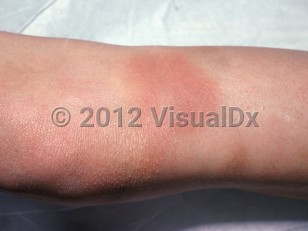 Clinical image of Von Willebrand disease - imageId=1556415. Click to open in gallery. 