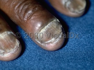 Clinical image of Scopulariopsis - imageId=155648. Click to open in gallery.  caption: 'Onycholysis with subungual debris and a whitish and yellowish color to the distal nail.'