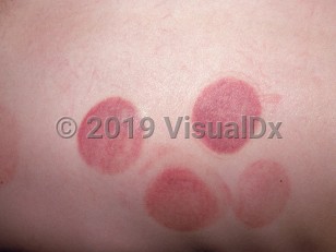 Clinical image of Cultural practices - imageId=1559772. Click to open in gallery.  caption: 'Circular pink and purpuric patches and plaques on the back, secondary to cupping.'