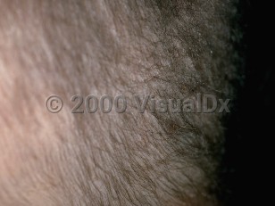 Clinical image of Monilethrix - imageId=156451. Click to open in gallery.  caption: 'Fine, wiry, broken-off scalp hair.'
