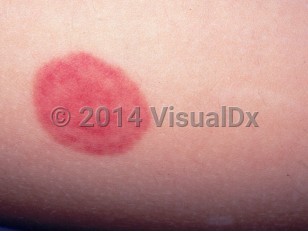Clinical image of Acute hemorrhagic edema of infancy - imageId=1584128. Click to open in gallery.  caption: 'A close-up of an oval erythematous plaque with overlying purpuric annuli.'