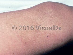 Clinical image of Bite marks of child abuse - imageId=1587612. Click to open in gallery.  caption: 'Tiny hemorrhagic crusts and postinflammatory hyperpigmented macules in geometric arrays on the leg.'