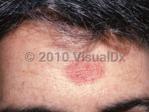Clinical image of Traumatic purpura - imageId=1587737. Click to open in gallery. 