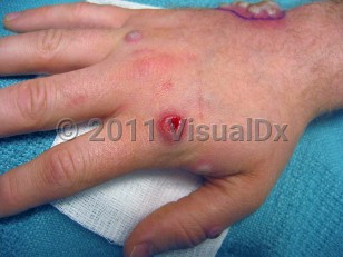 Clinical image of Monkeypox - imageId=1589825. Click to open in gallery.  caption: 'Numerous large pustules, some single and some clustered, some crusted and one ulcerated, on the hand and thumb.'