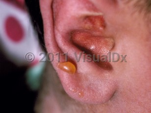 Clinical image of Acute graft-versus-host disease - imageId=159679. Click to open in gallery.  caption: 'Tense vesicles and background erythema on the ear.'