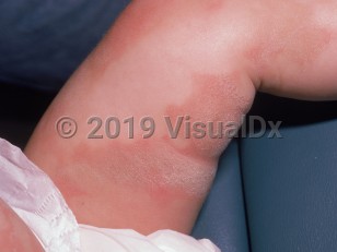 Clinical image of Erythrokeratodermia variabilis - imageId=1607091. Click to open in gallery.  caption: 'Patterned, scaly, yellowish, and erythematous plaques with surrounding erythematous macules and patches on the leg.'