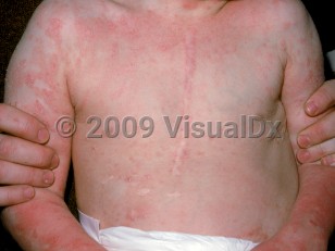 Clinical image of CHIME syndrome - imageId=1616761. Click to open in gallery.  caption: 'Widespread thin, erythematous papules and plaques with overlying fine scale on the trunk and arms.'