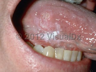 Clinical image of Oral squamous cell carcinoma - imageId=161727. Click to open in gallery. 
