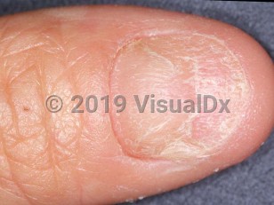 Clinical image of Artificial nail damage - imageId=1644067. Click to open in gallery.  caption: 'Distal nail atrophy after application of artificial nails.'