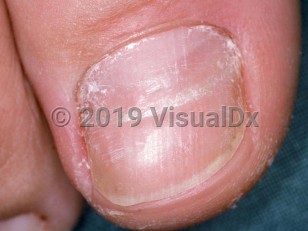 Clinical image of Beau lines - imageId=1644608. Click to open in gallery.  caption: 'A transverse groove in the nail plate with some associated superficial scaling.'