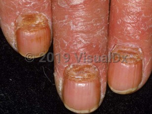 Clinical image of Dermatitis of nail folds - imageId=1646592. Click to open in gallery.  caption: 'Scaly, erythematous plaques on the distal fingers abutting the proximal nailfolds with secondary nail dystrophy (multiple transverse lines and onychomadesis).'