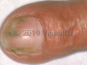 Clinical image of Hairdresser's nails - imageId=1649980. Click to open in gallery.  caption: 'Distal onycholysis and hair shafts visible through the nail plate.'