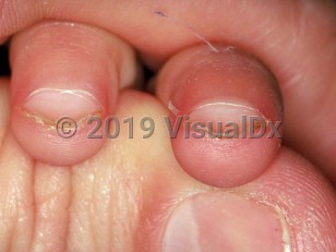 Clinical image of Infantile koilonychia - imageId=1651699. Click to open in gallery.  caption: 'Spoon-shaped fingernails in a toddler.'