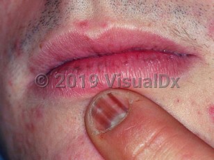 Clinical image of Laugier-Hunziker syndrome - imageId=1653517. Click to open in gallery.  caption: 'Longitudinal pigmented bands of a fingernail and grayish macules on the lower lip.'