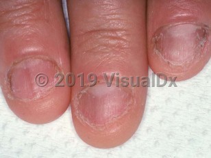 Clinical image of Nail biting - imageId=1655004. Click to open in gallery.  caption: 'Distal fraying of the nails, enlarged lunulae, and faint longitudinal melanonychia.'