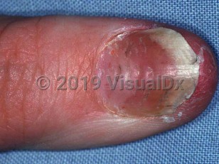 Clinical image of Parakeratosis pustulosa - imageId=1658268. Click to open in gallery.  caption: 'Coarse nail pits.'