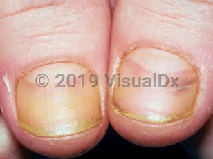 Clinical image of Pesticide-induced nail changes - imageId=1658944. Click to open in gallery.  caption: 'Yellow discoloration of fingernails due to dinobuton.'