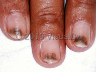 Clinical image of Photoonycholysis - imageId=1659036. Click to open in gallery.  caption: 'Half-moon-shaped, red, purple-black, and brown subungual discoloration of the distal fingernails.'