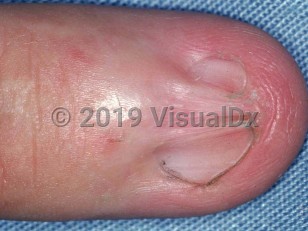 Clinical image of Nail pterygium - imageId=1661066. Click to open in gallery.  caption: 'Dorsal pterygium of the fingernail. The proximal nail fold projection is fused with the underlying nail matrix, with division of the nail plate into 2 lateral wings.'