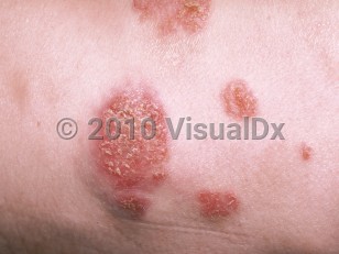 Clinical image of Cryptococcosis