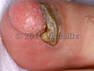 Clinical image of Subungual fibroma - imageId=1663452. Click to open in gallery.  caption: 'A pink nodule with overlying scant scale at the distal toe, causing lifting of the toenail.'