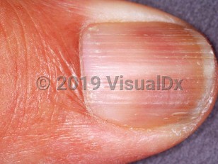 Clinical image of Tobacco staining of nails - imageId=1665608. Click to open in gallery.  caption: 'Yellow-brown staining of the distal part of the nail plate. Onychorrhexis is also apparent.'
