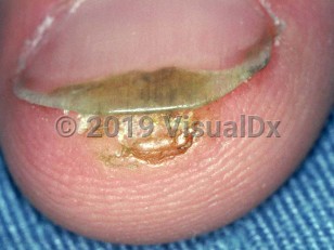 Clinical image of Subungual wart - imageId=1666494. Click to open in gallery.  caption: 'A crusted and verrucous papule at the fingertip, extending under the nail.'