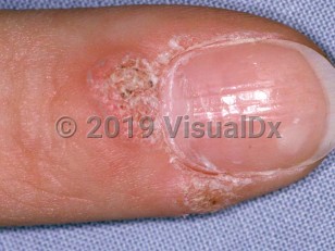 Clinical image of Periungual wart - imageId=1667003. Click to open in gallery.  caption: 'Verrucous papules at the proximal and lateral nailfold.'