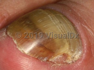 Clinical image of Worn down nails - imageId=1667333. Click to open in gallery.  caption: 'Transverse and longitudinal overcurvature and yellow discoloration of the great toenail.'