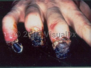 Clinical image of Septicemic plague - imageId=1670846. Click to open in gallery.  caption: 'Necrosis of the distal digits appearing as black, crusted plaques with loss of some of the fingernails.'