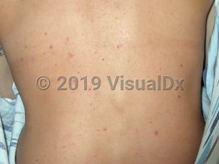 Clinical image of Vaccinia-Induced folliculitis - imageId=1673059. Click to open in gallery.  caption: 'Scattered pink follicular papules on the back.'