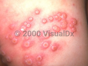 Clinical image of Eczema vaccinatum vaccinia