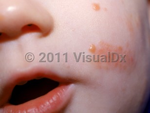 Clinical image of Benign cephalic histiocytosis - imageId=1694021. Click to open in gallery.  caption: 'Smooth orangey papules (and unrelated scaly plaques of irritant dermatitis) on the cheek.'