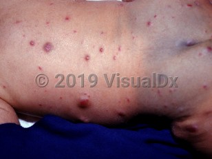 Clinical image of Diffuse neonatal hemangiomatosis - imageId=1707372. Click to open in gallery.  caption: 'Multiple red and violaceous papules and nodules on the back, buttocks, and thigh. Note also the unrelated gray patches of congenital dermal melanocytosis on the buttocks.'
