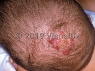 Clinical image of PHACE syndrome - imageId=1708188. Click to open in gallery.  caption: 'A sizeable deep red plaque (hemangioma) on the scalp.'
