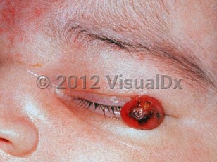 Clinical image of Congenital neuroblastoma - imageId=1708320. Click to open in gallery.  caption: 'A bright red papule with overlying hemorrhagic crust on the eyelid.'