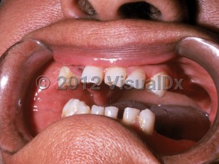 Clinical image of Early congenital syphilis - imageId=1708799. Click to open in gallery.  caption: 'Notched, widely-spaced teeth (Hutchinson teeth).'