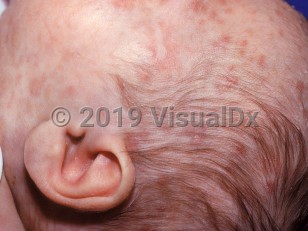 Clinical image of Acute myelomonocytic leukemia - imageId=1709060. Click to open in gallery.  caption: 'Widespread pink papules and plaques of varying thickness, on the face and scalp.'
