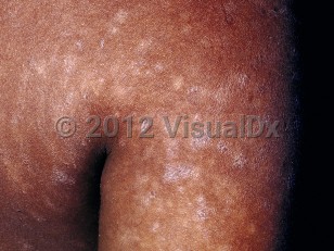 Clinical image of Pityriasis lichenoides chronica - imageId=17098. Click to open in gallery.  caption: 'Scaly, flat-topped, violaceous papules and plaques and postinflammatory hypopigmented macules on the arm and shoulder area.'
