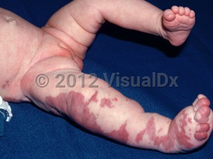 Clinical image of Klippel-Trenaunay syndrome