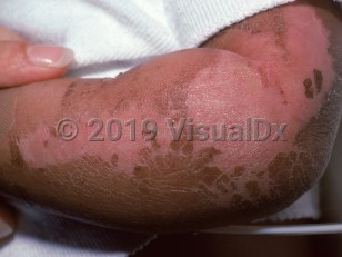 Clinical image of Kwashiorkor - imageId=1718296. Click to open in gallery.  caption: 'Widespread thick scales with a "flaky paint" appearance on the arm and residual pink hypopigmentation in areas where desquamation has occurred.'