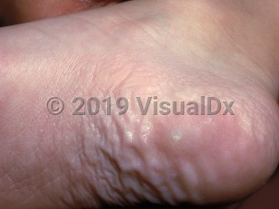 Clinical image of Calcified nodules of the heels
