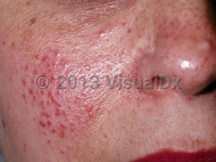 Clinical image of Lupus miliaris disseminatus faciei - imageId=175152. Click to open in gallery.  caption: 'Multiple tiny, red-brown papules and pink erythema of the cheek.'