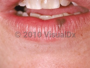 Clinical image of Oral melanotic macule - imageId=175614. Click to open in gallery.  caption: 'A brown macule on the lower lip.'