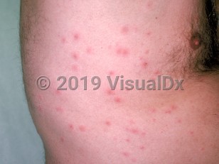 Clinical image of Pseudomonas folliculitis - imageId=175997. Click to open in gallery.  caption: 'Numerous erythematous and edematous perifollicular papules on the flank.'